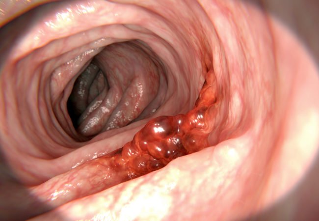 ColorectalCancer-650x450.jpg