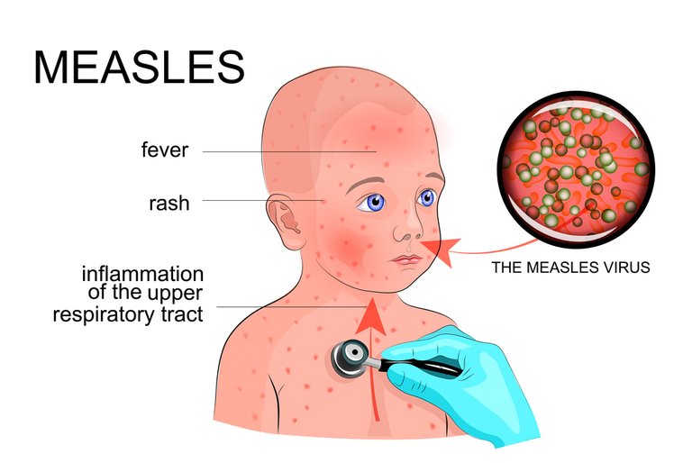 measles-in-children.jpg