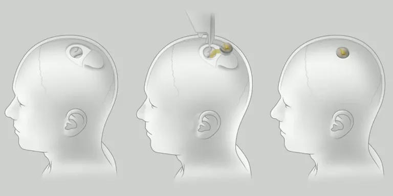 neuralink-surgery.webp