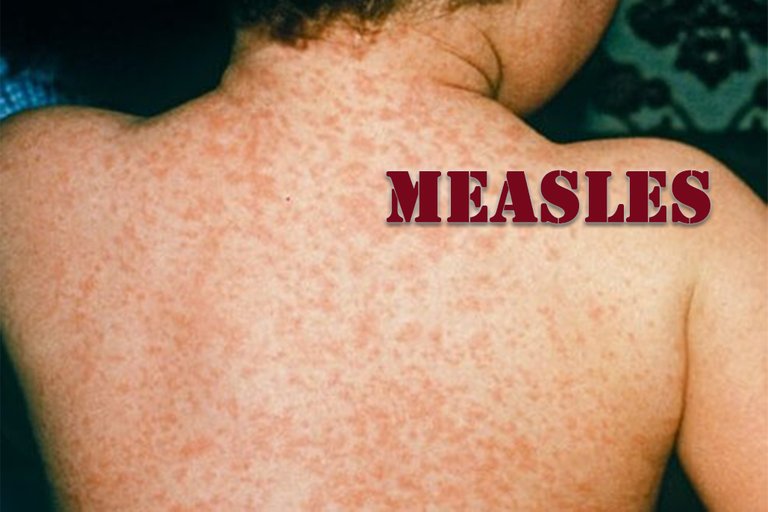 measles.jpg