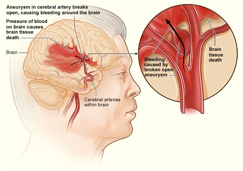 Stroke_hemorrhagic.jpg