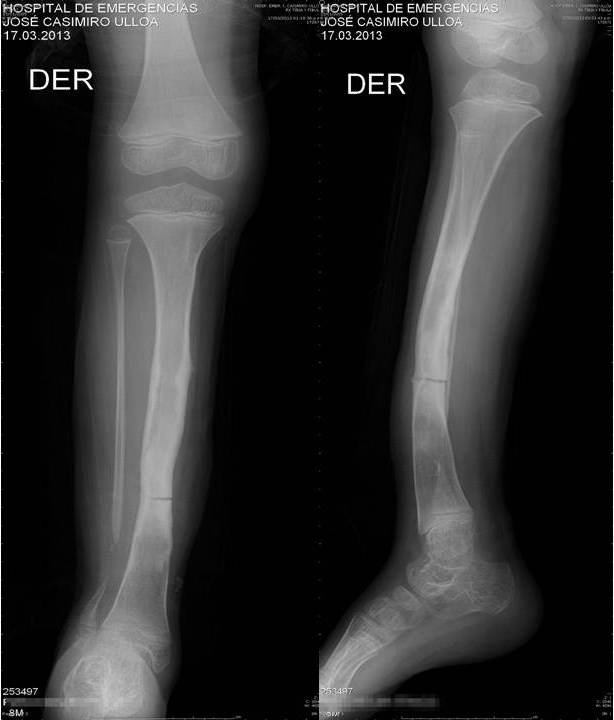 PSEUDO ARTROSIS  DE TIBIA RX.jpg