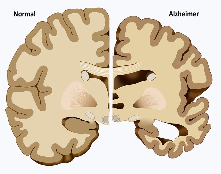 ALZHEIMER.jpg