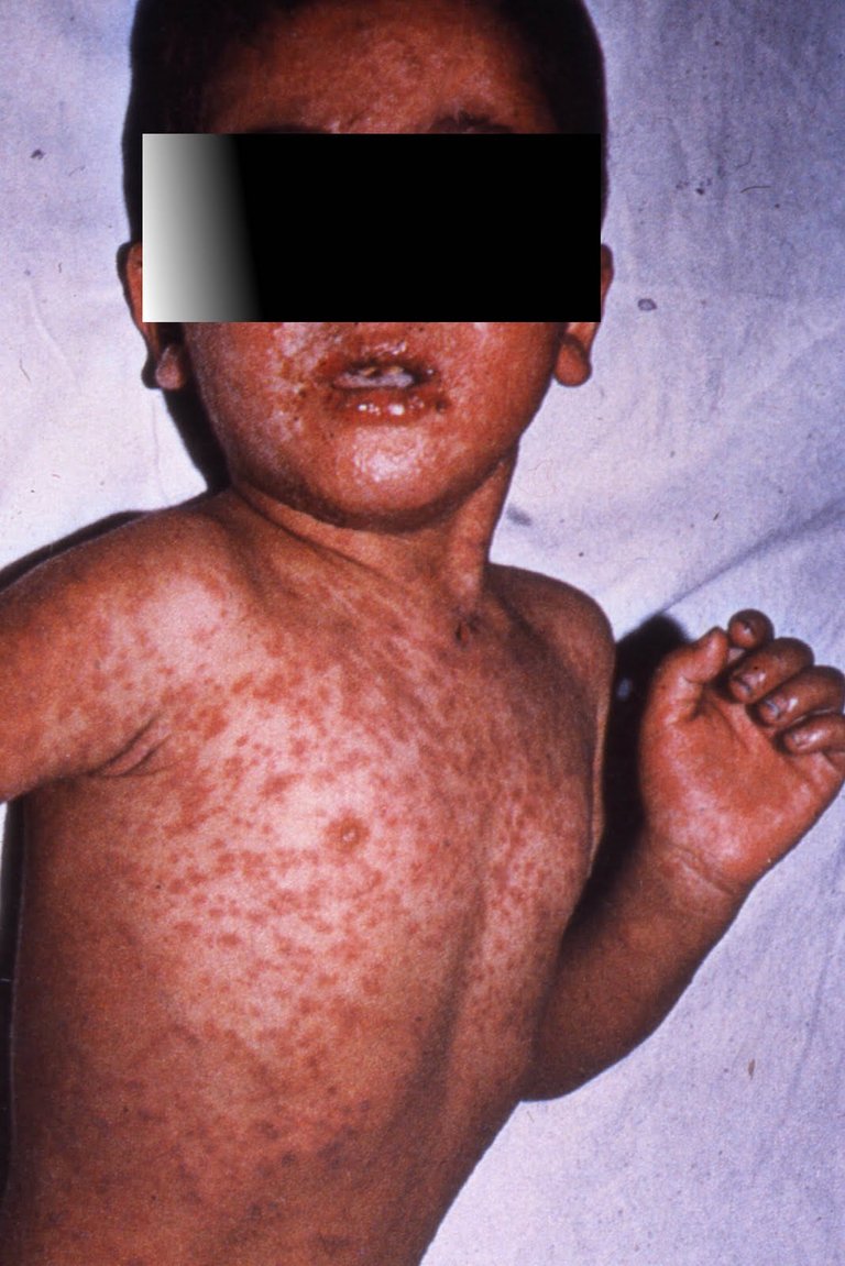 measles 3b.jpg