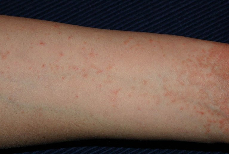 800px-Acarodermatitis_Arm.jpg