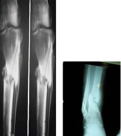 Figura-N2-Retardo-de-la-consolidacion-y-pseudoartrosis-de-tibia-radiologia.png