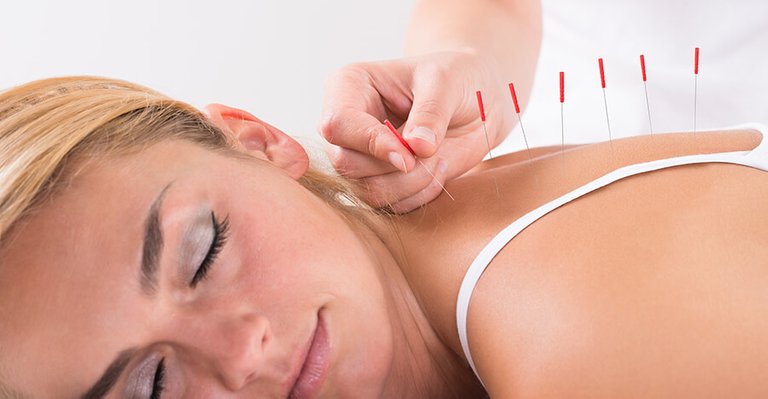 Acupuncture-treatment.jpg