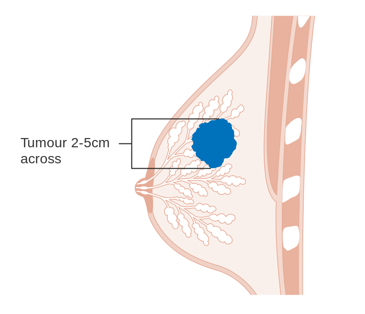 750px-Diagram_showing_stage_T2_breast_cancer_CRUK_252.svg.png