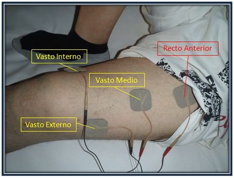 Electrodos cuadriceps.JPG