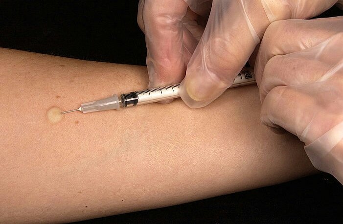 800px-Mantoux_tuberculin_skin_test-1.jpg