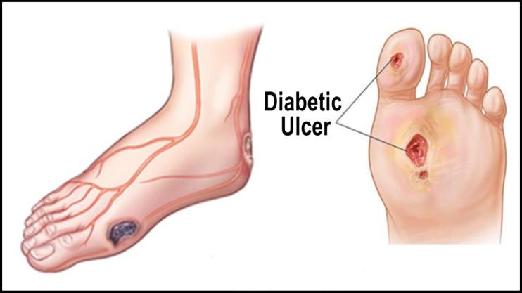 Diabetic-Foot-Ulcers.jpg