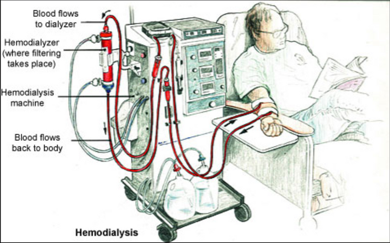 hemodialysis illustration.PNG