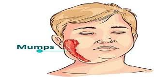 mumps.jfif