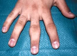 Rheumatoid arthritis in hands.jpg