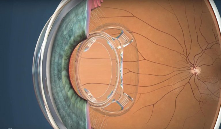 iReviews-bionic-lens-ocumetics_3.jpg