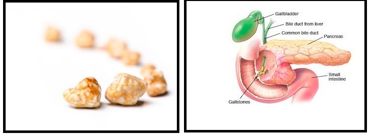 gallstones400x265.jpg