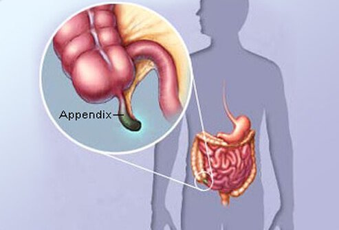 appendicitis_s1_appendix_illustration.jpg