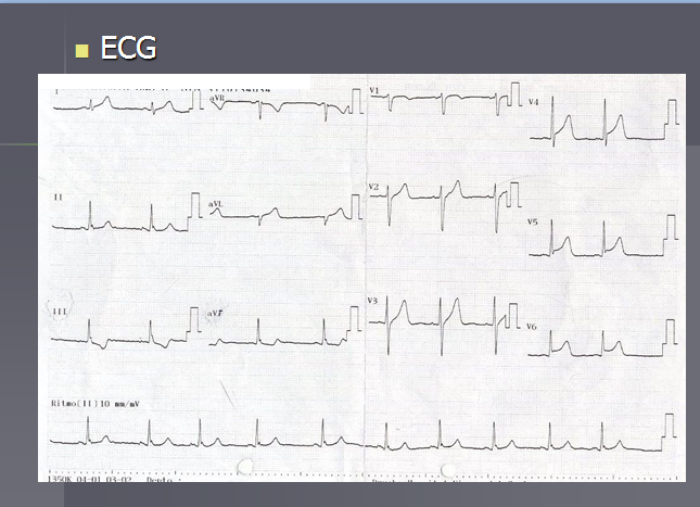 ecg sx coronario.png