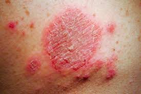 eczema4.jpg