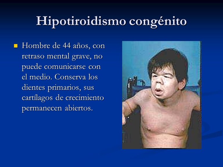 Hipotiroidismo+congénito.jpg