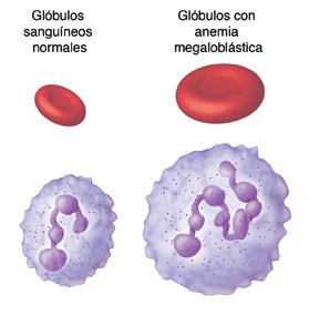 Deficiencia-congenita-de-factor-intrinseco.jpg