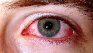 uveitis-300x171.jpg