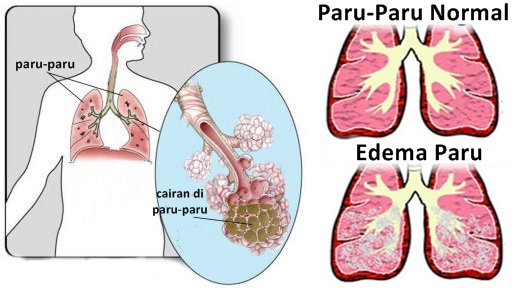 edema-paru-eye.jpg