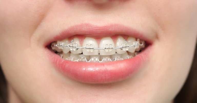 Invisible-Braces-Dubai-Cost-Prices-Reviews.jpg