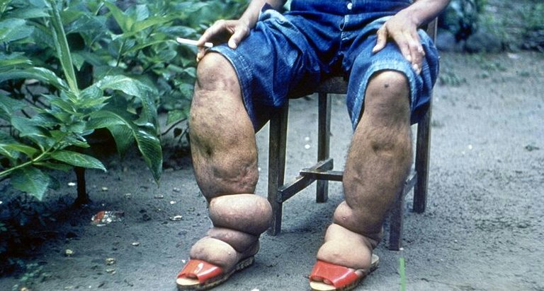 800px-Elephantiasis-1.jpg