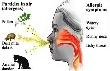 allergic_rhinitis_causes.jpg