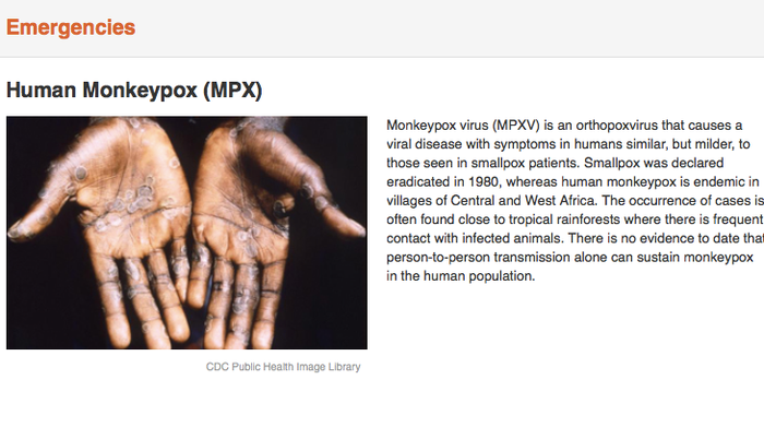 Human Monkeypox (MPX).jpg