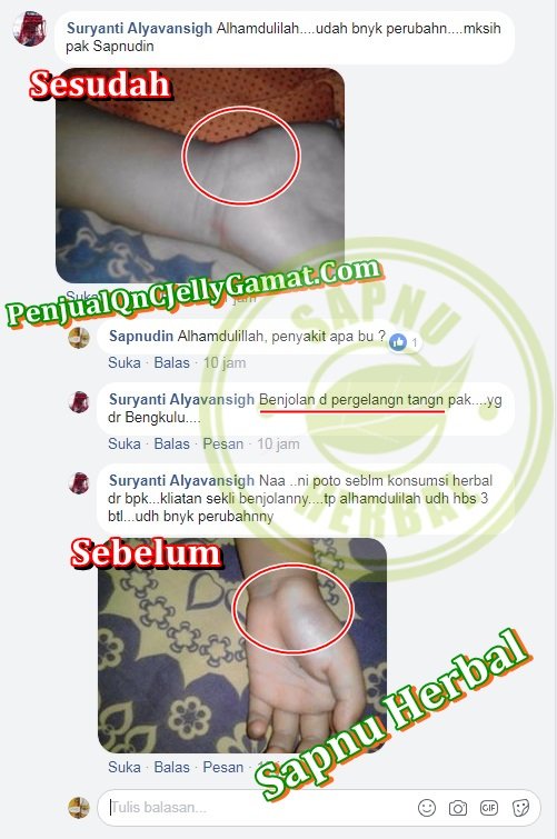 Testimoni QnC Jelly Gamat ~ benjolan di pergelangan tangan - lipoma - kulit.jpg