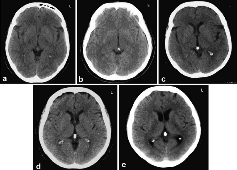 Illustrative-cases-a-pineal-gland-with-no-calcification-with-a-degree-score-of-0-in-a.png