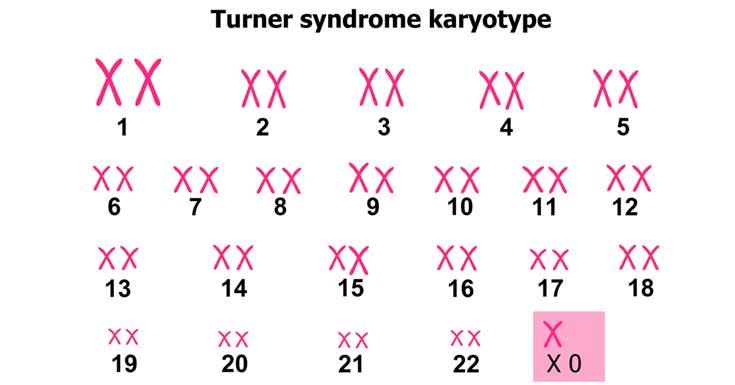 turner-syndrome.jpg