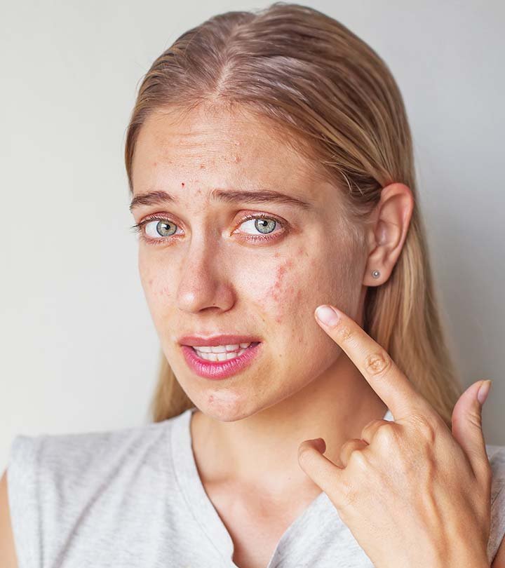 ACNE 123.jpg