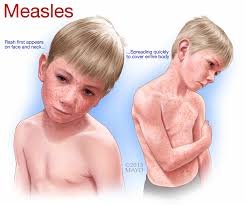 measles.jfif