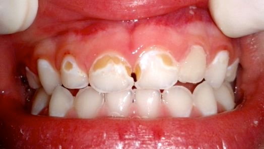 Caries-dientes-leche.jpg