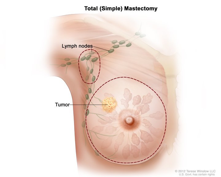 Total_(simple)_mastectomy.jpg