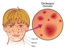 chicken pox.jfif