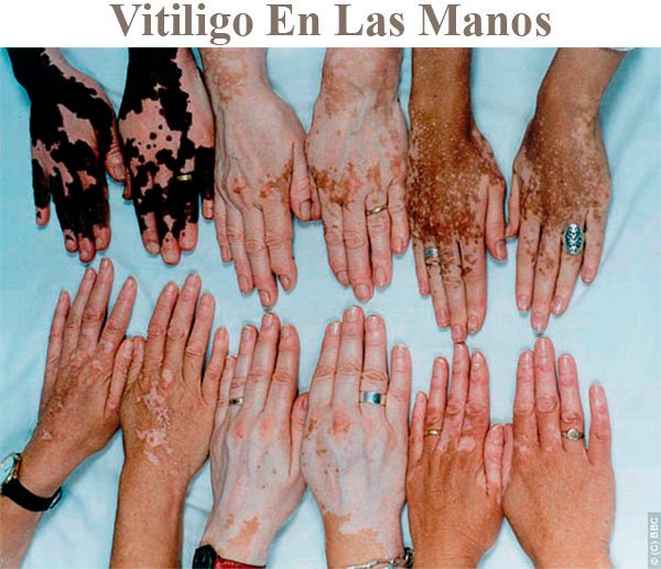 VITILIGO-EN-LAS-MANOS.jpg