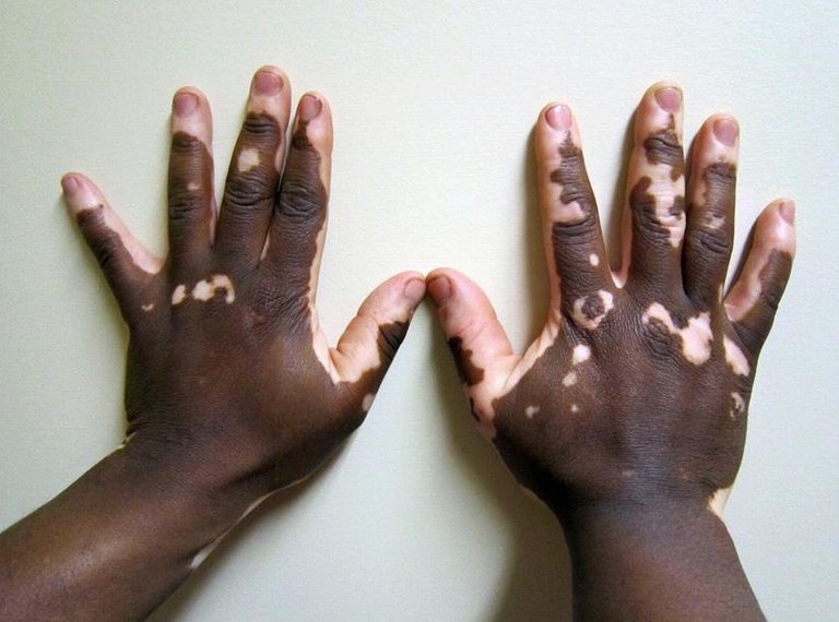 Vitiligo.JPG