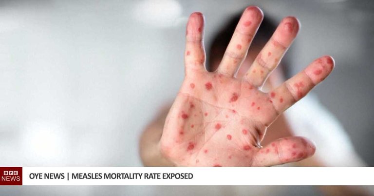 measles-mortality-rate-exposed.jpg