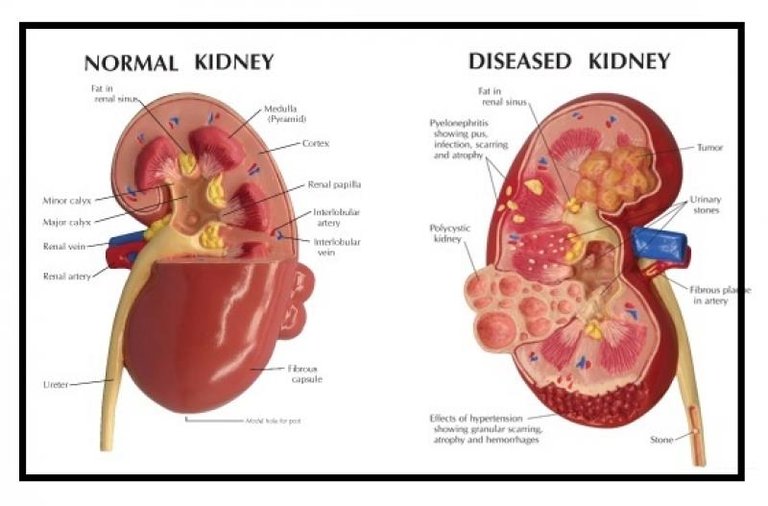 feature-kidney.jpg