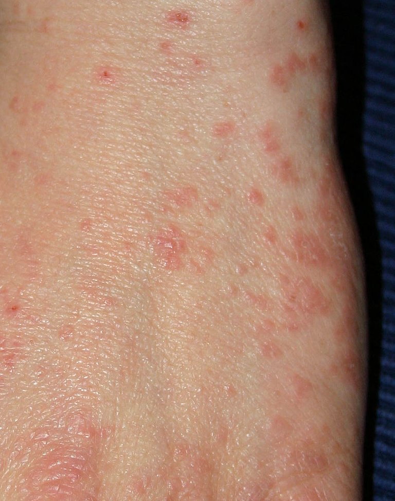 800px-Acarodermatitis_Hand.jpg