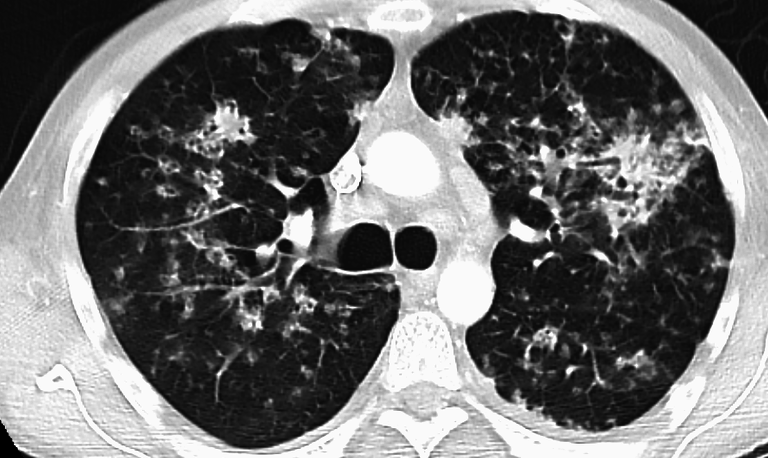 PulmonaryTB (1)-1.png