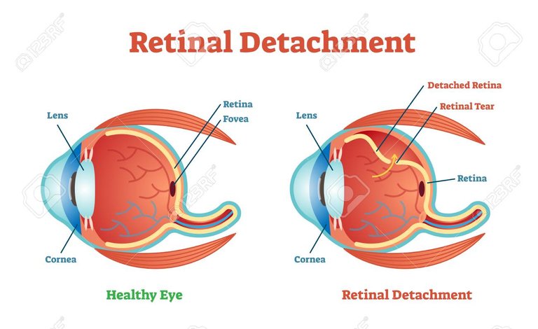 94537221-retinal-detachment-vector-illustration-diagram-anatomical-scheme-medicinal-educational-information-.jpg