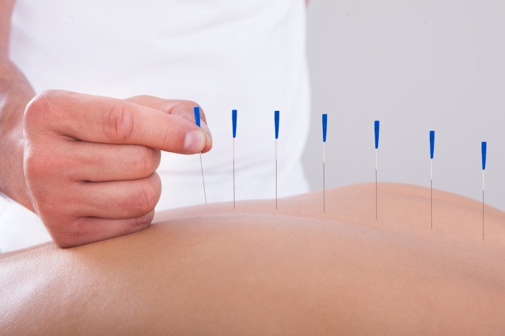 Acupuncture-732x488.jpg