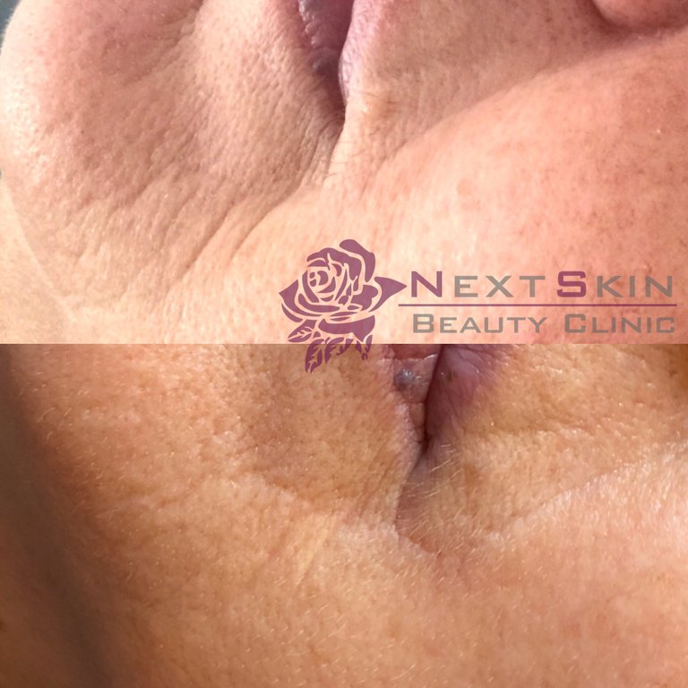 microneedling behandeling voor en na foto.JPG