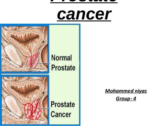 prostate-cancer-1-638.jpg