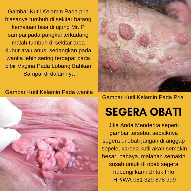 Gambar Kutil Kelamin.jpg